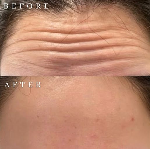 Forehead lines before and after Botox