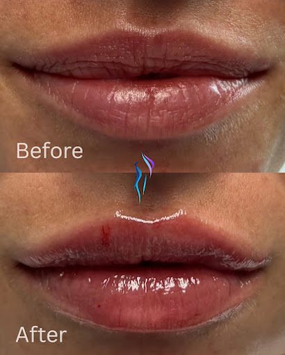 Lips before and after dermal filler