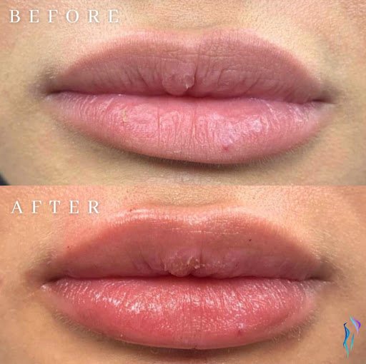 Lips before and after dermal filler treatment